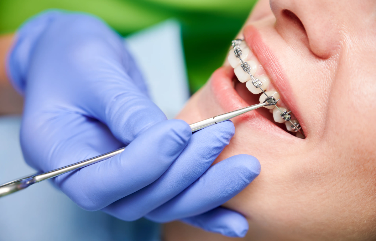 Metal Braces