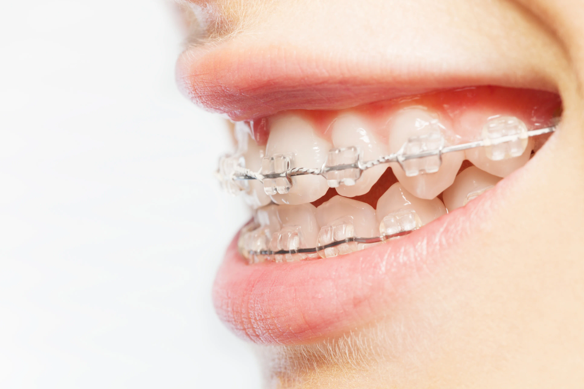 Clear Braces